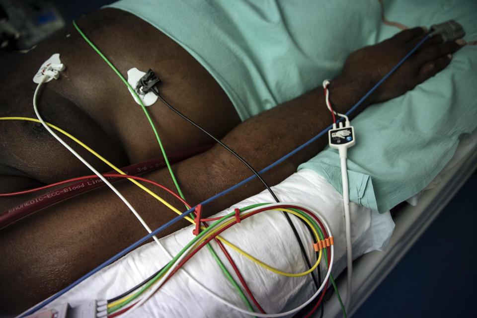 A Covid-19 patient under ECMO (Extracorporeal membrane oxygenation) remains unconscious, at Bichat Hospital, AP-HP, in Paris, Thursday, April 22, 2021. France still had nearly 6,000 critically ill patients in ICUs this week as the government embarked on the perilous process of gingerly easing the country out of its latest lockdown, too prematurely for those on pandemic frontlines in hospitals. President Emmanuel Macron's decision to reopen elementary schools on Monday and allow people to move about more freely again in May, even though ICU numbers have remained stubbornly higher than at any point since the pandemic's catastrophic first wave, marks another shift in multiple European capitals away from prioritizing hospitals. (AP Photo/Lewis Joly)