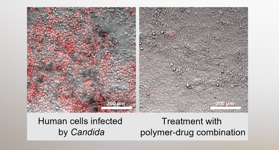 Human cells infected with Candida albicans over a period of 24 hours. On left: untreated, with damaged human cells indicated by a red dye. On right: after treatment with the synthetic polymer, which indicates the prevention of infection.