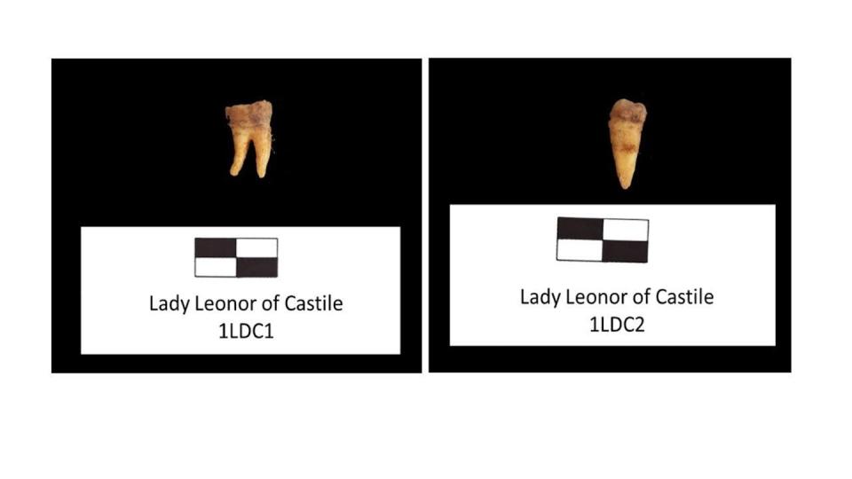 Piezas dentales de la Infanta Leonor seleccionadas para el análisis genético. <a href="https://www.mdpi.com/2313-5778/7/2/28" rel="nofollow noopener" target="_blank" data-ylk="slk:Palomo-Díez et al. 2023.;elm:context_link;itc:0;sec:content-canvas" class="link ">Palomo-Díez et al. 2023.</a>, <a href="http://creativecommons.org/licenses/by/4.0/" rel="nofollow noopener" target="_blank" data-ylk="slk:CC BY;elm:context_link;itc:0;sec:content-canvas" class="link ">CC BY</a>