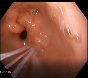 Caption: Pure-Vu EVS irrigation jets washing a biopsy site in the Upper GI tract