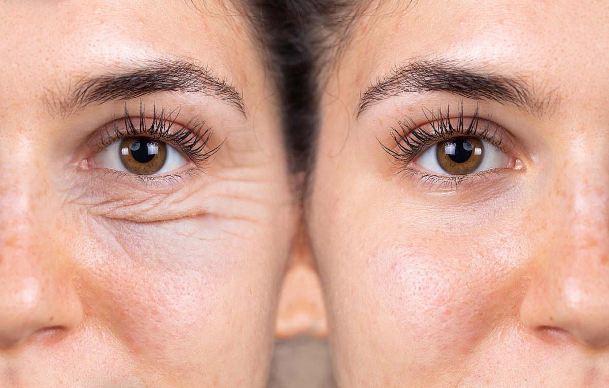 Wrinkle-Free in 2 Minutes! This Under-Eye Cream Is Like Magic