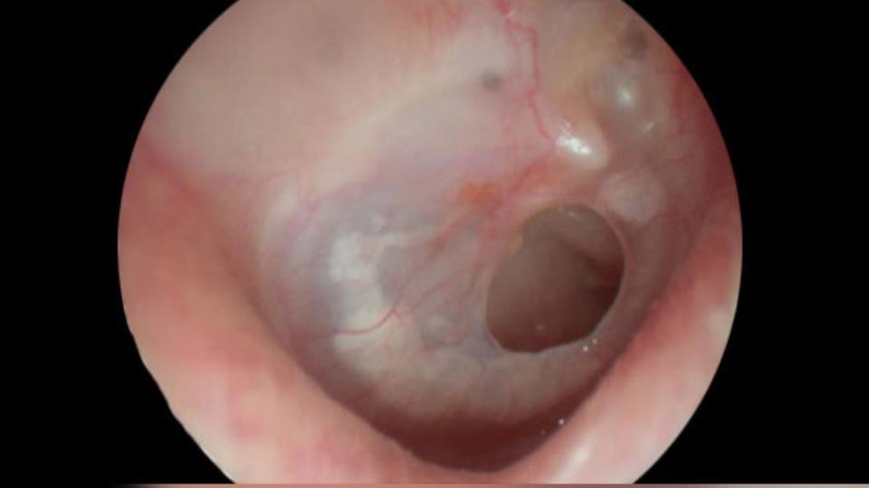 潛水客上岸後耳鳴、聽不清楚，就醫驚見耳膜破洞。（圖／台北中山醫院）