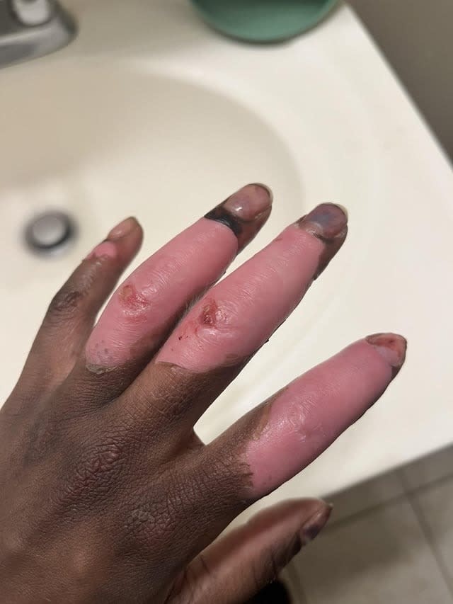 hand is different colors
