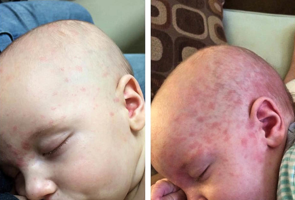 Mobius was 4 months old when he became sick with measles after visiting Disneyland in 2015. Babies are vulnerable because they aren’t routinely vaccinated against the virus until 12 to 15 months. (Ariel Loop)