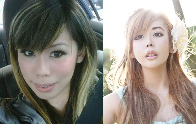 Jacqueline Koh before (left) and after (her) surgery (Photo courtesy of Jacqueline Koh)