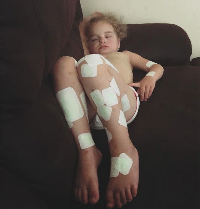 Jazmyn's legs covered in dressings after receiving skin grafts to repair dead tissue that ravaged her skin. Photo: Facebook/Jazmyn's meningococcal B journey