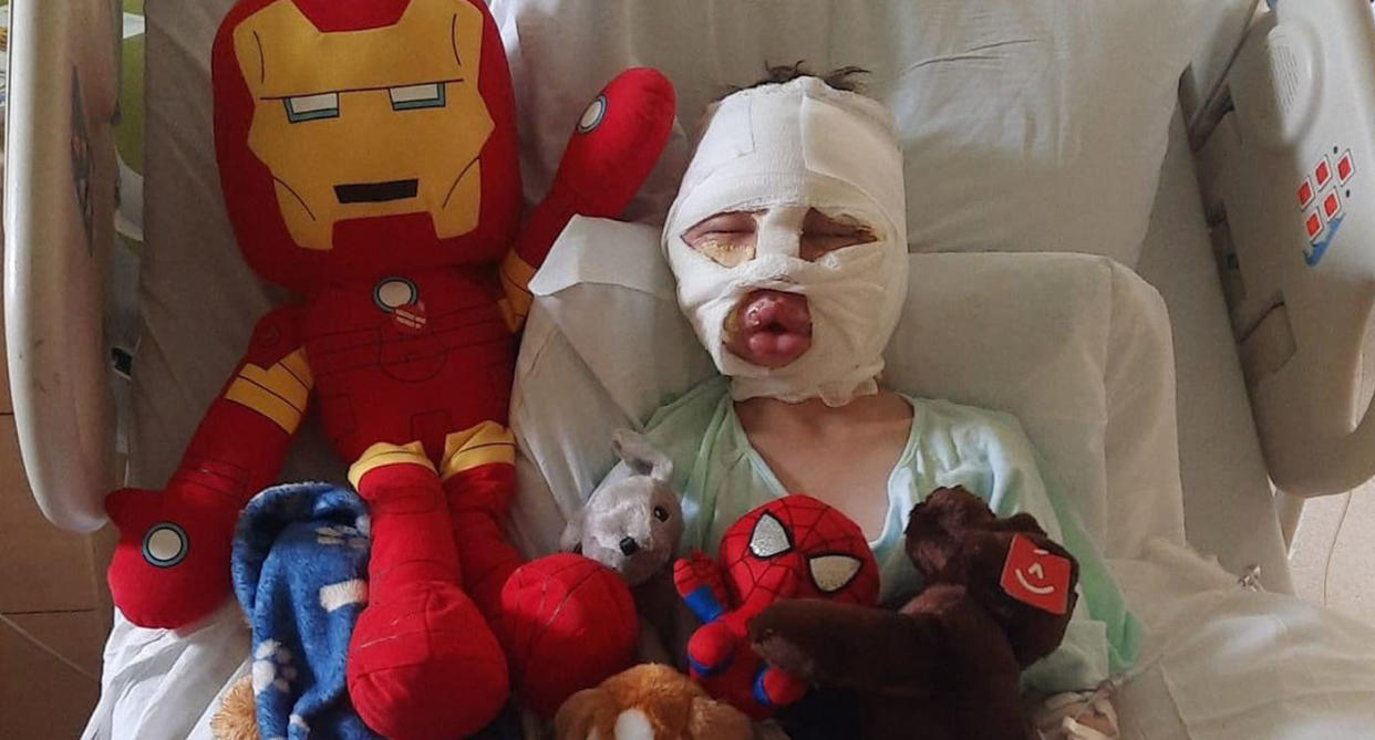  six-year-old boy Dominick Krankall in hospital covered in bandages with superhero toys