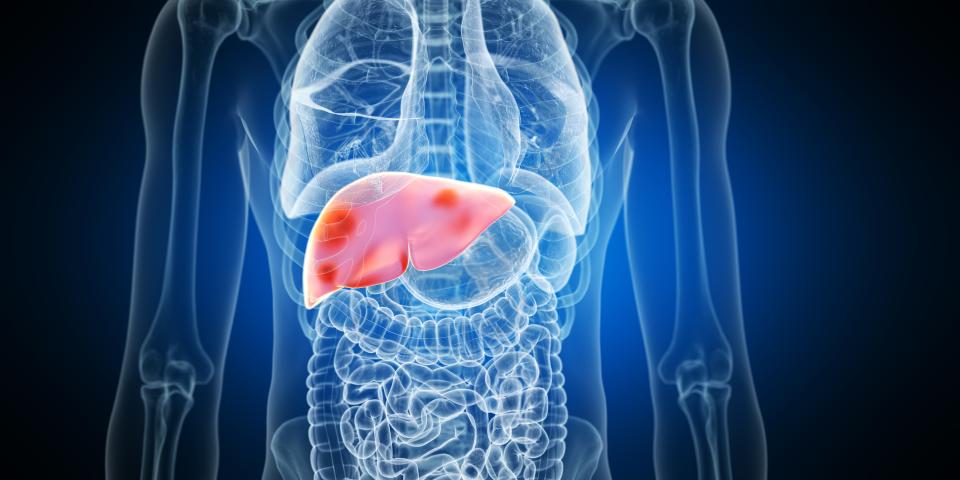 Liver tumours, illustration.