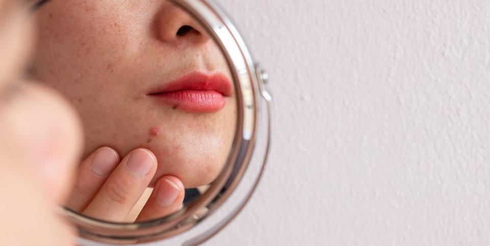 cropped shot of woman worry about her face when she saw the problem of acne occur on her chin by a mini mirror