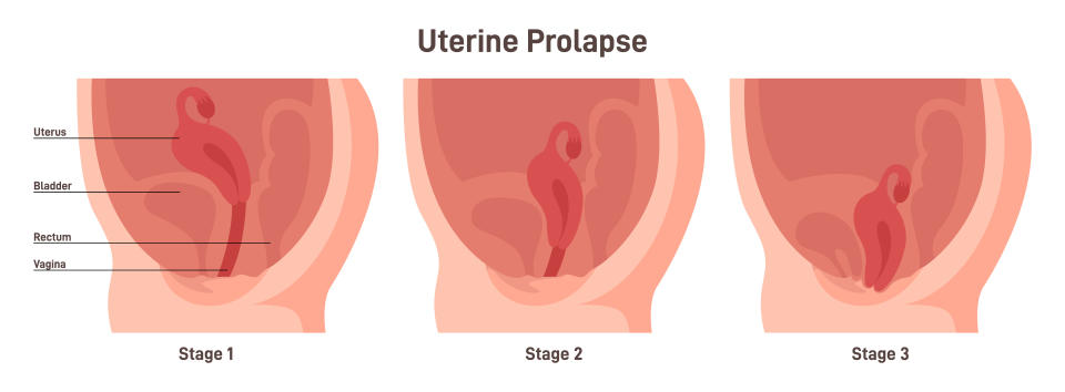 Stages of uterine prolapse. Pelvic floor muscles weakening, Support for the uterus loss. Flat vector illustration