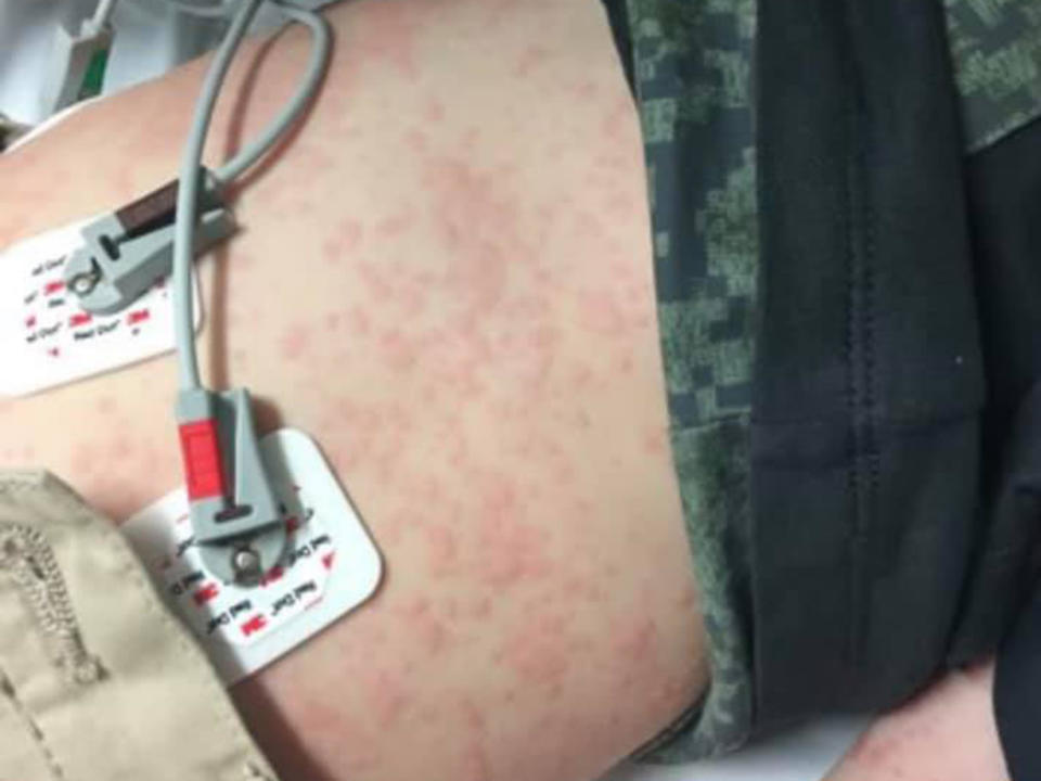 it was the worst reaction he has ever had, his family says. Image: Facebook/Allergy & Anaphylaxis Australia