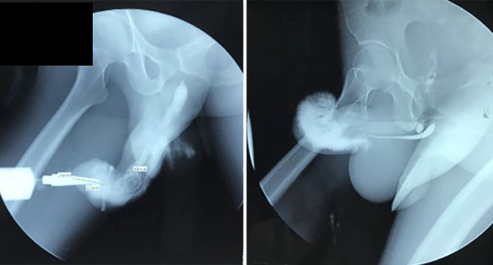 An x-ray of the man's penis.