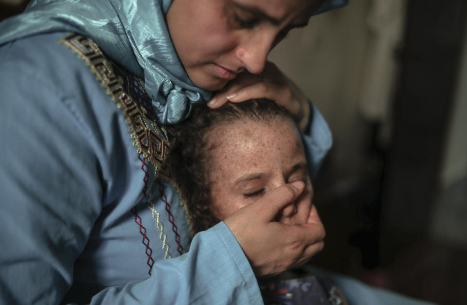 In this Tuesday, July 23, 2019 photo, Maria El Maroufi, shares a moment with her 6 year-old daughter Romaisae who is affected by a rare disorder called xeroderma pigmentosum, or XP, in their home in the town of Sale, near Rabat, Morocco. (AP Photo/Mosa'ab Elshamy)