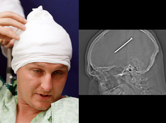 Chicago's Dante Autullo unknowingly shot a nail into his skull and posted a picture of the X-ray on Facebook during his ambulance ride between hospitals for surgery. Autullo underwent surgery to remove the 3-1/4-inch nail lodged in his brain and is recovering.(AP Photo/Christ Medical Center & Hope Children's Hospital)