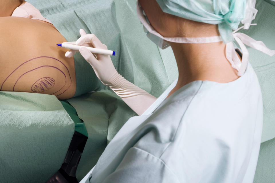 Liposuction, also called lipoplasty or body contouring, removes unwanted fat from certain parts of the body, but it isn't a weight-loss alternative. (Photo via Getty Images)