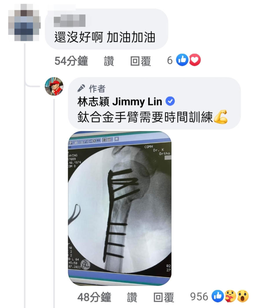 林志穎曬出X光照，讓許多人心疼。（圖／截取自林志穎facebook）