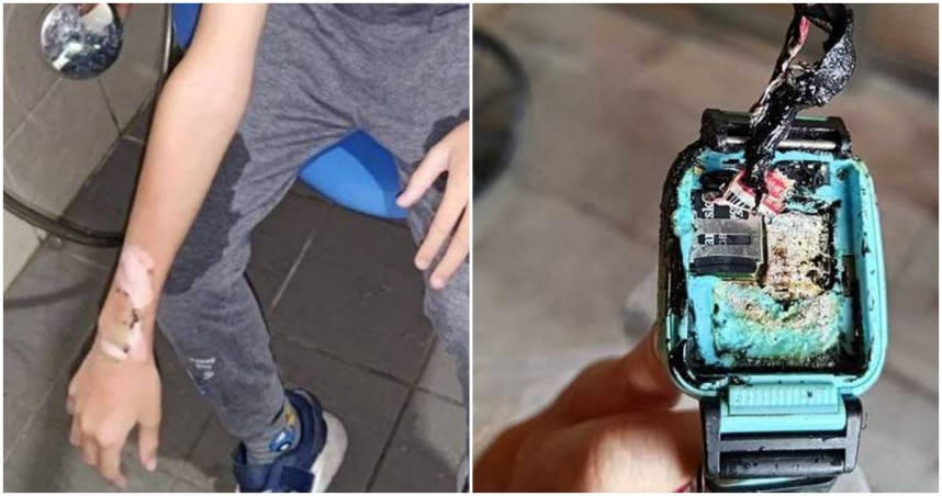 男童戴智慧型手錶，突爆炸手臂灼傷。（圖／三立新聞提供）