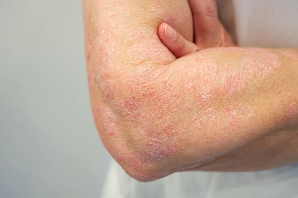 Psoriasis on arm and hand. (Photo: Alamy/PA)