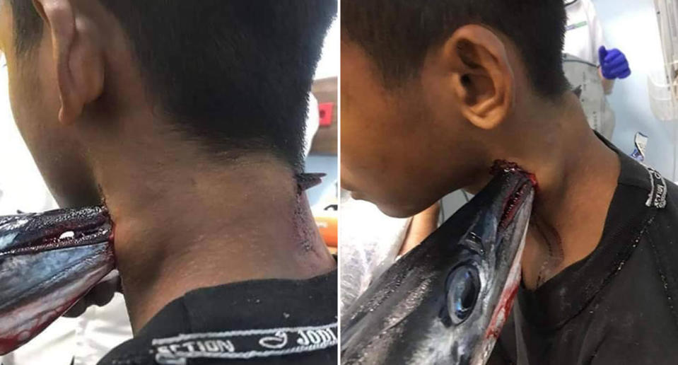 Muh Idul is pictured with a needlefish piercing through his neck.