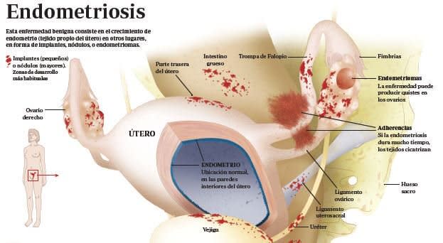 Infografía Endometriosis: Servicio de Ginecología del Hospital Clinic de Barcelona/Dr. Francisco Carmona Herrera