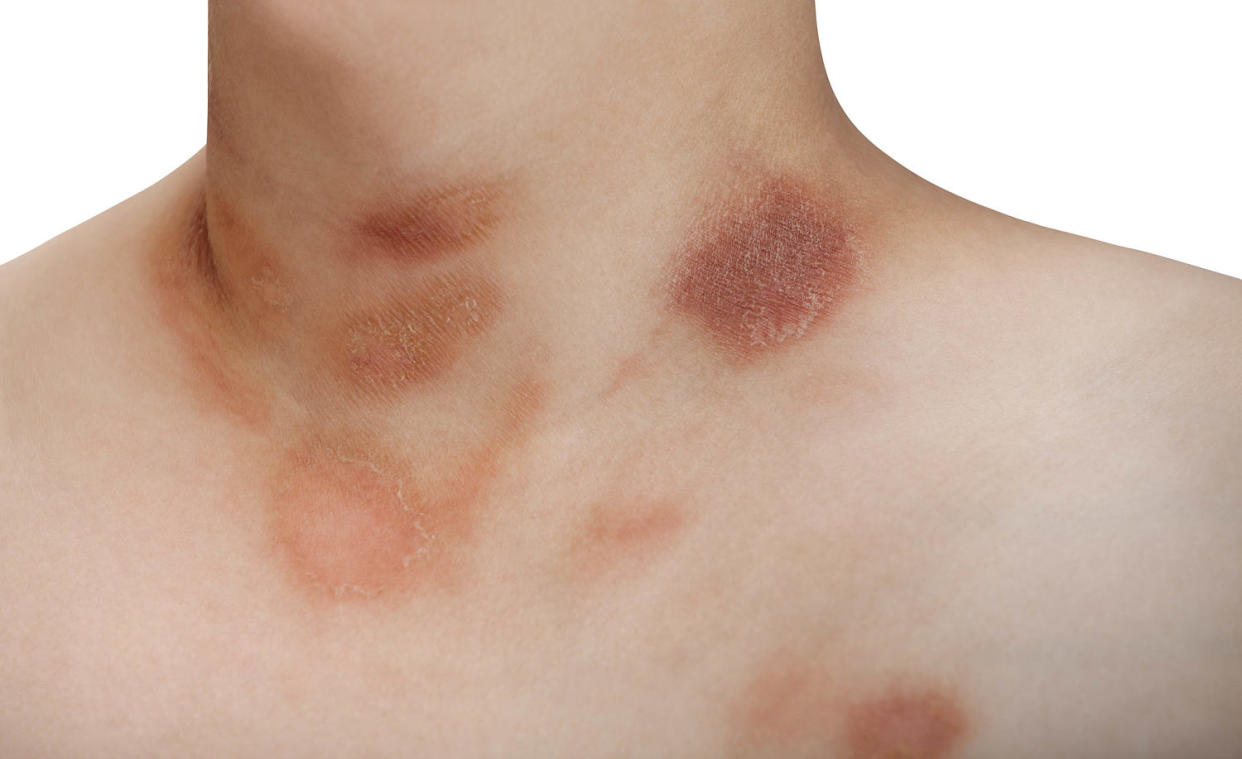 One person with Pityriasis rosea disease on the chest and neck (Getty Images)