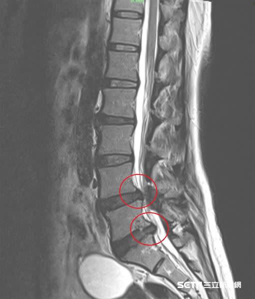 患者葉小姐因為腰椎狹窄處，壓迫神經，導致出現腰痛情形，嚴重時下肢痠麻無力。（圖／台北慈濟醫院提供）