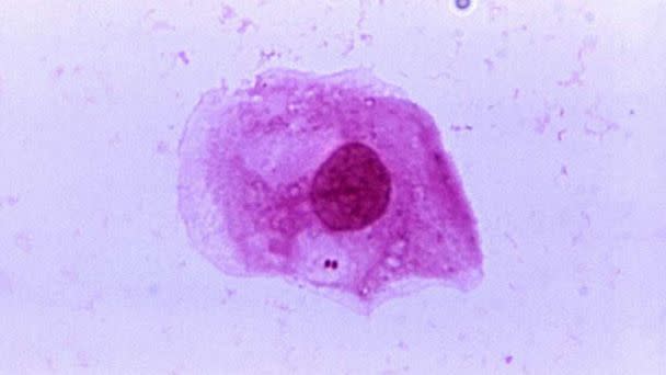 PHOTO: A photomicrograph of Neisseria meningitidis recovered from the urethra of an asymptomatic male. (Centers for Disease Control and Prevention)
