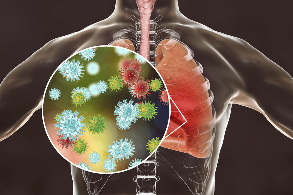 Viruses in human lungs, 3D illustration. Conceptual image for viral pneumonia, flu, MERS-CoV, SARS, Adenoviruses and other respiratory viruses