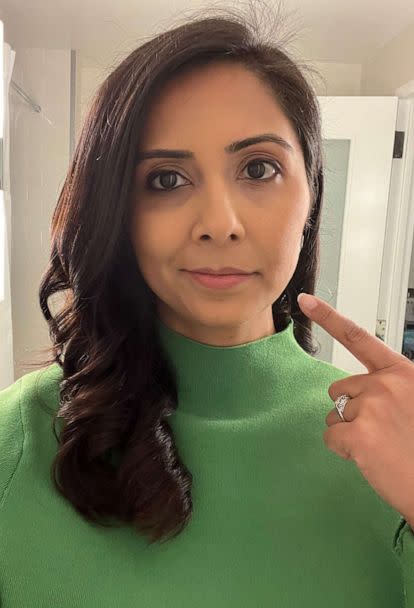 PHOTO: Zohreen Shah was diagnosed with Bell's palsy in January. She's pointing to the side of her face that temporarily could not move (ABC News)