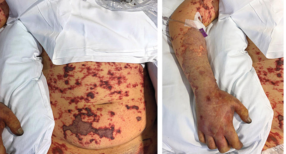 Photos of the 19-year-old man who had a rash that spread quickly, resulting in his fingers and legs being amputated. 