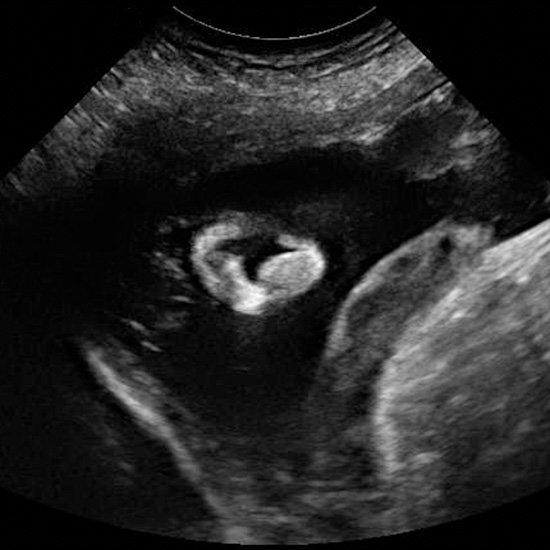 We've partnered with the American Institute of Ultrasound Medicine (AIUM), Johns Hopkins, and the March of Dimes to create this unique peak into Baby's development inside the womb. These images reveal all the intricate details of your baby's growth -- from a collection of cells to a full-term newborn. While most women may only receive one or two ultrasounds during pregnancy, which is normal, this slideshow of the 2nd trimester of pregnancy gives you a look at each week of development.