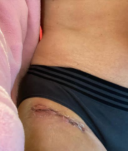 <p>Paulina Porizkova/Instagram</p> Paulina Porizkova showing off her scars after her hip replacement