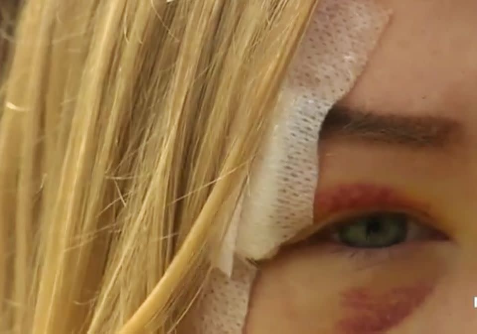 The 18-year-old still bares the scars of the vicious brawl. Photo: 7 News