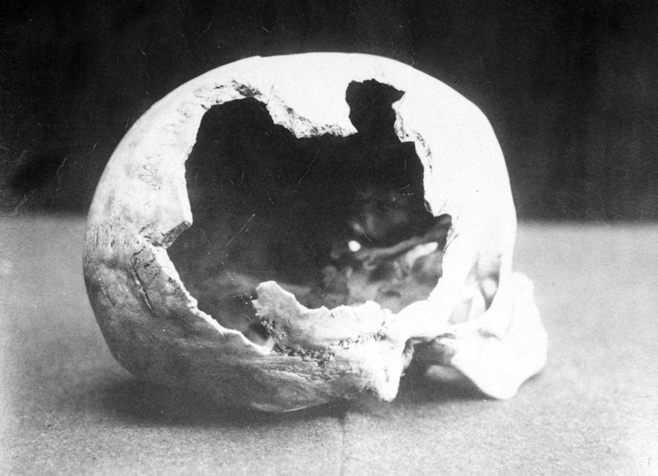 The skull of Abby Borden. She suffered 19 blows to the head. / Credit: Fall River Historical Society