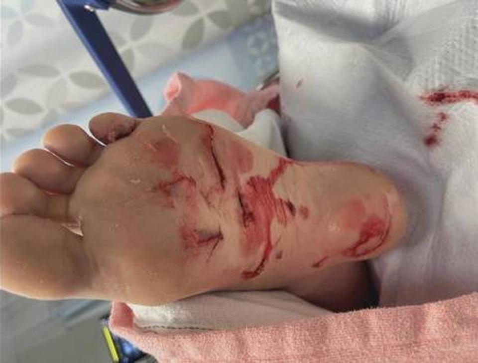 The 15-year-old suffered cuts to her foot and calf and needed six stitches (CBS News Philadelphia)