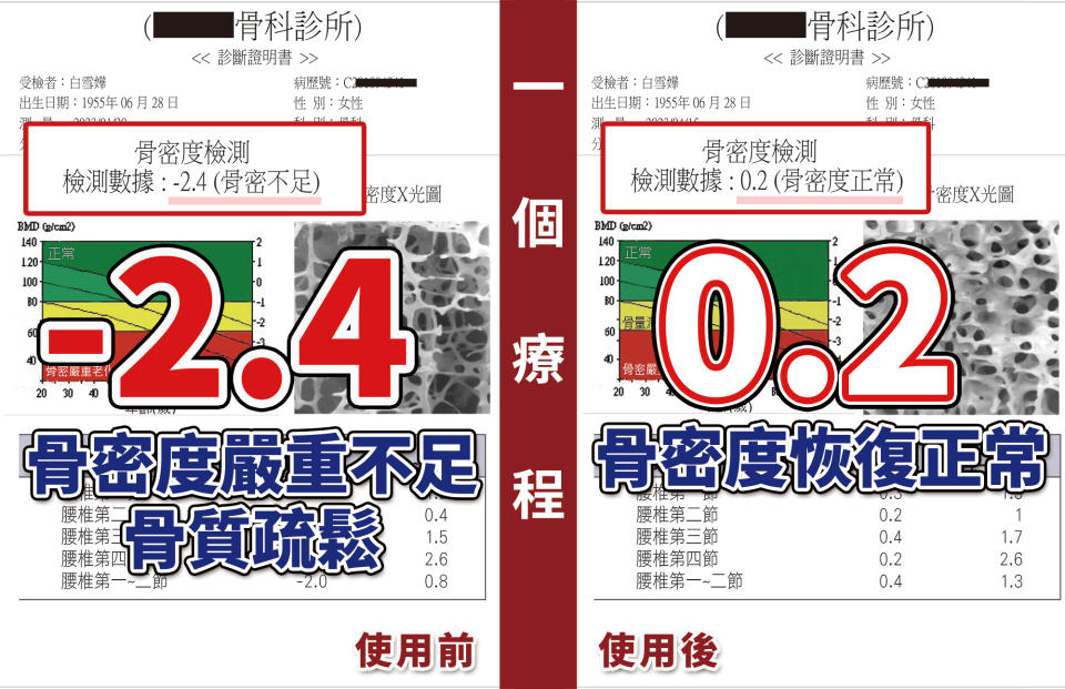 冰冰姐日前做骨密度檢測（BMD），正常值在+1.0 至-1.0之間，結果發現她骨密度T值-2.4，骨密嚴重老化，骨質疏鬆，膝關節重度退化，需要長年復健無法久站。