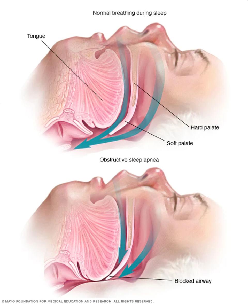 Comparación entre la respiración normal durante el sueño (imagen superior) y la obstrucción de las vías aéreas de la apnea del sueño (imagen inferior). Foto: Clínica Mayo