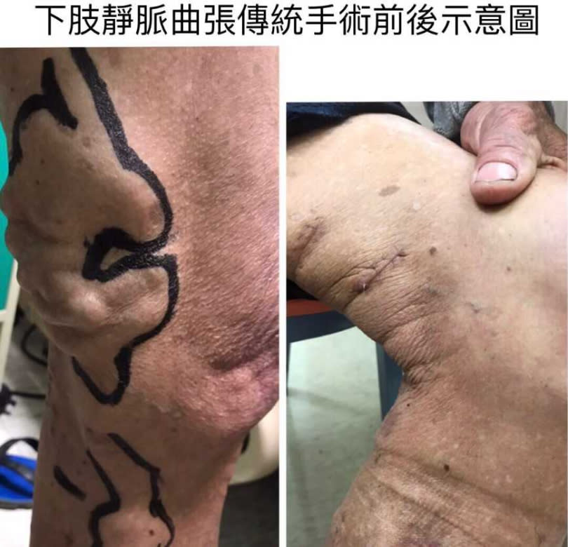 患者經手術後已逐漸康復。