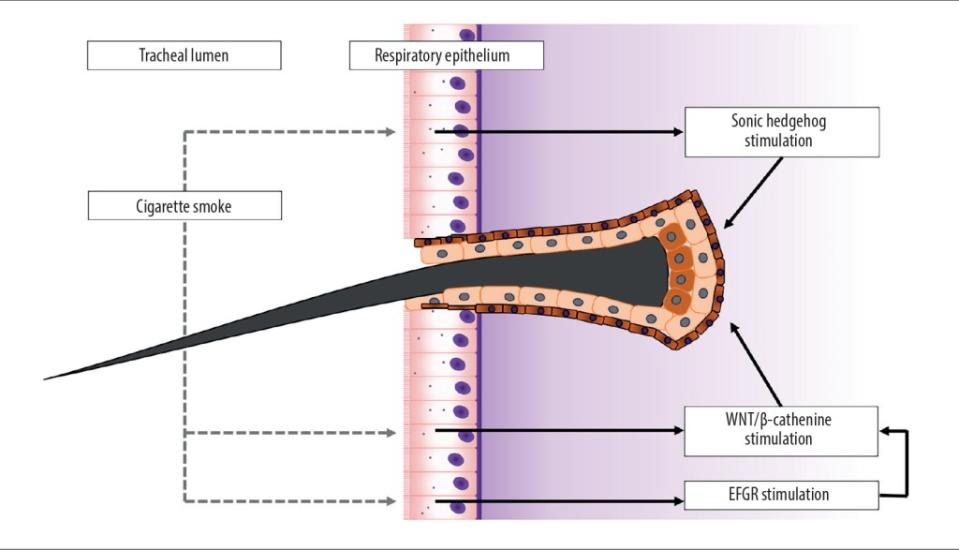 Inflammation of throat cells, a consequence of smoking, can spur hair growth. American Journal of Case Reports