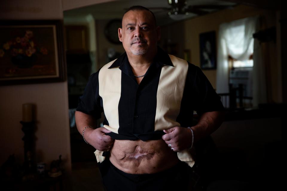 Ricardo “Rick” Martinez was hospitalized in 2013 after Dr. Amaryllis Pascual perforated his small bowel in multiple places and committed other errors during liposuction. Martinez, now 56, shows his scar.