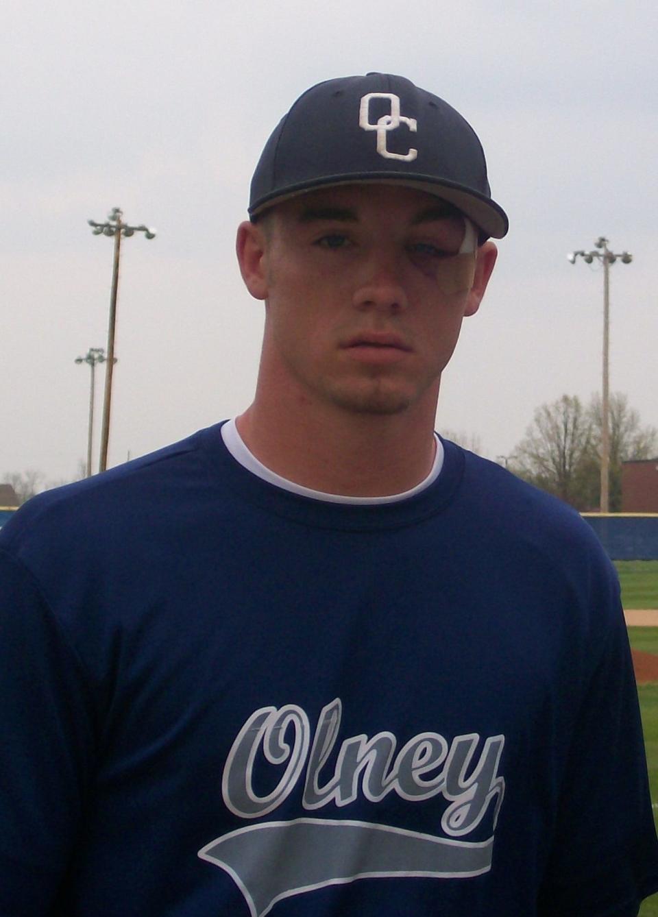 Troy Ellis with a swollen eye after getting hit with a pitch while playing for Olney Community College.