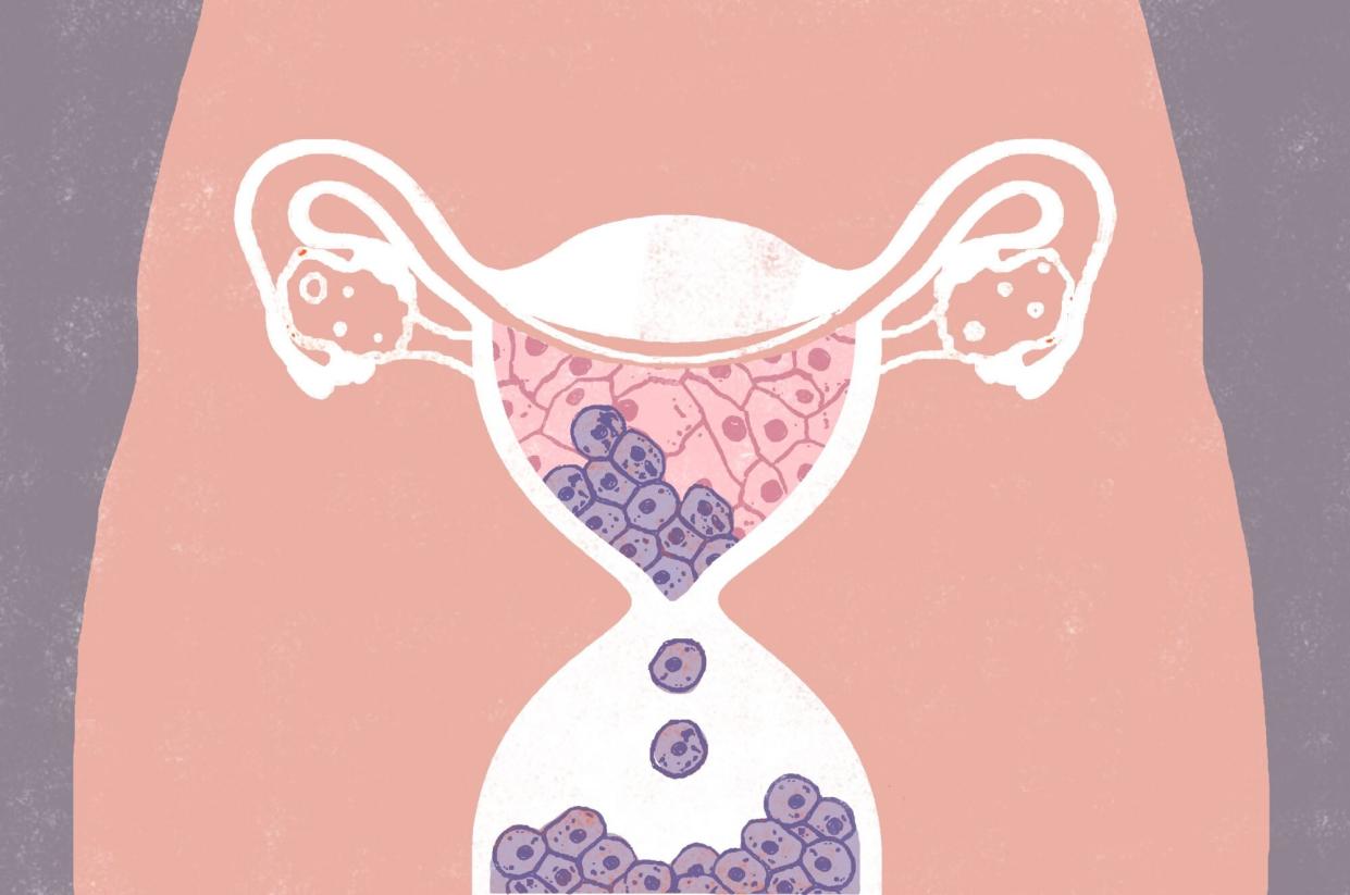 illustration of uterus with cancer cells that is shaped like an hourglass