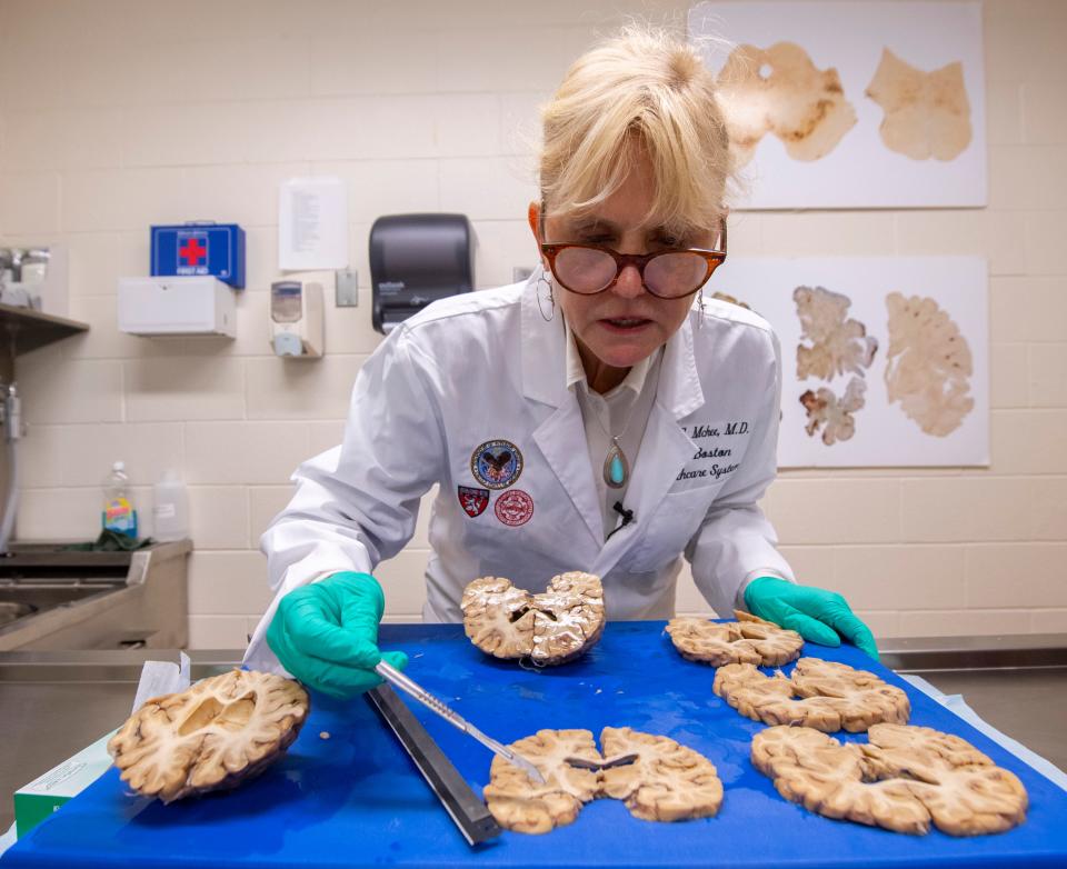 Dr. Ann C. McKee, director of Boston University's CTE Center, examines a brain in 2018.