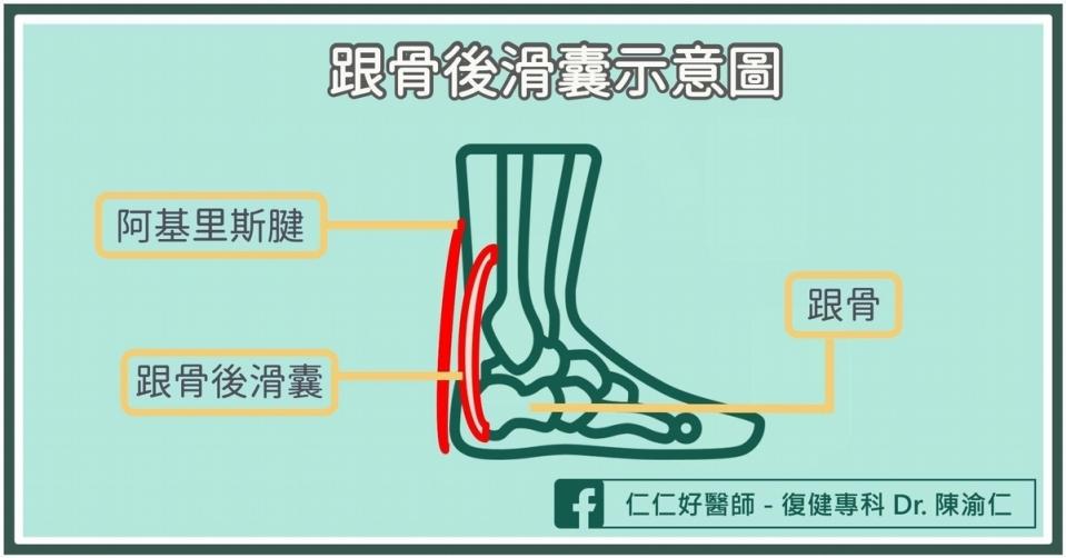 跟骨後滑囊炎是什麼？