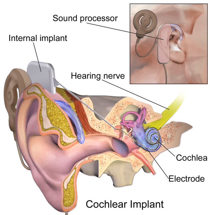 <span class="caption">Cochlear implants are usually just put in one of the user’s ears.</span> <span class="attribution"><a class="link " href="https://en.wikipedia.org/wiki/Cochlear_implant#/media/File:Blausen_0244_CochlearImplant_01.png" rel="nofollow noopener" target="_blank" data-ylk="slk:BruceBlaus/Wikimedia Commons;elm:context_link;itc:0;sec:content-canvas">BruceBlaus/Wikimedia Commons</a>, <a class="link " href="http://creativecommons.org/licenses/by/4.0/" rel="nofollow noopener" target="_blank" data-ylk="slk:CC BY;elm:context_link;itc:0;sec:content-canvas">CC BY</a></span>