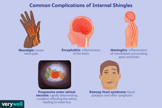 Shingles in the Eye: Symptoms, Complications, and Treatment