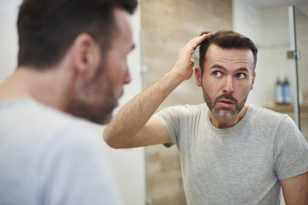 Man with hair loss. (Getty Images)