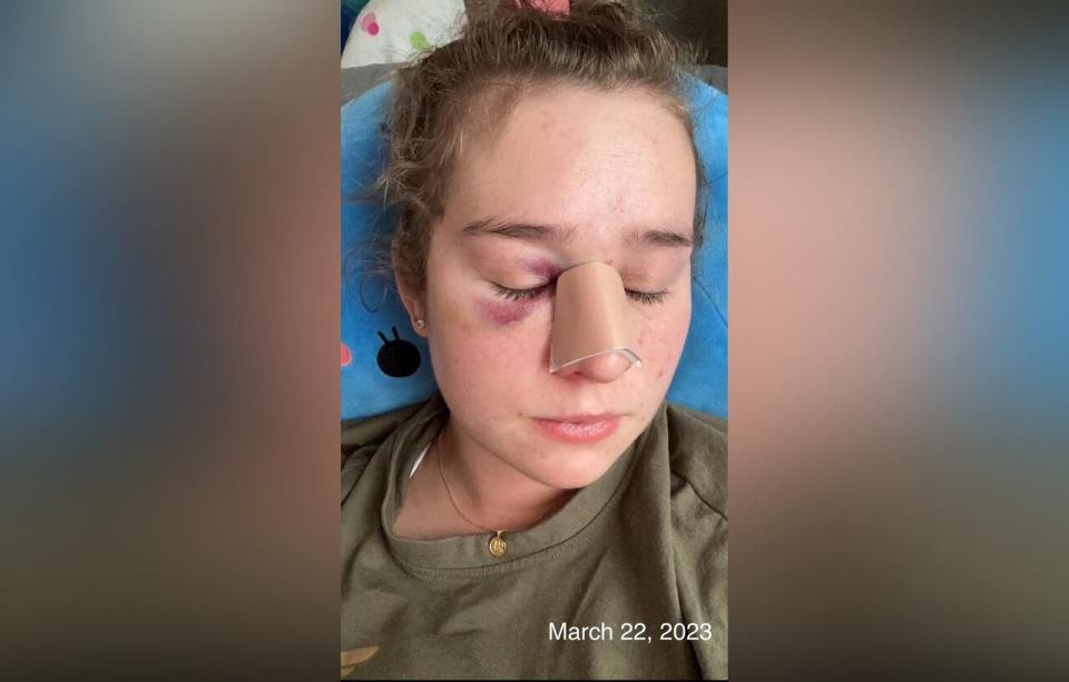 Shelby was a teacher in Saskatchewan during March 2023 when she was assaulted by a student. She suffered a broken nose and a severe concussion.