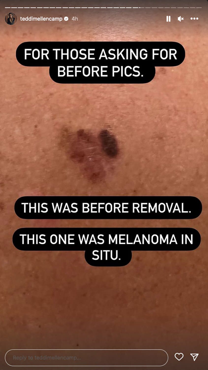 Teddi Mellencamp skin cancer diagnosis https://www.instagram.com/stories/teddimellencamp/2946807631327306448/