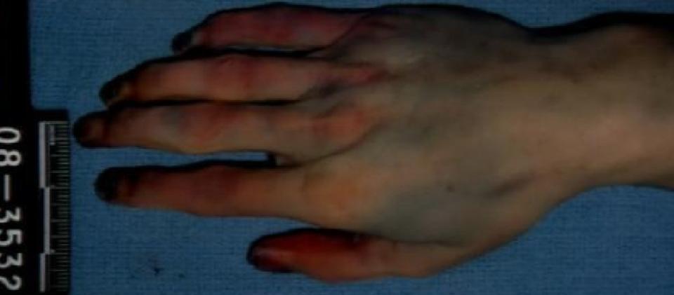 The prosecution contends this photo, shown in court on Jan. 8, 2013, shows Travis Alexander had multiple self-defense wounds to his palms and fingers that indicate he had fought for his life during the knife attack.